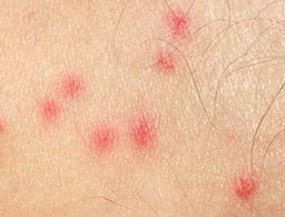 cluster of bed bug bites