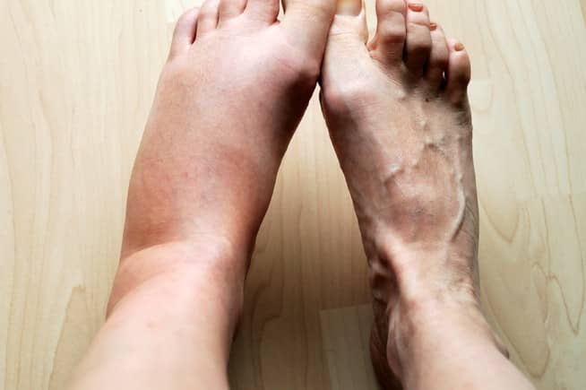 Comparison of swollen foot from bee sting