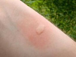 mosquito bite